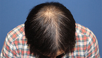 30代 男性 H.Y.さん　前頭部・頭頂部 自毛植毛（MIRAI法） 2,100株の症例（施術後）