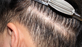 30代 男性 I.Y.さん　瘢痕 自毛植毛（NC-MIRAI法） 400株の症例（施術前）
