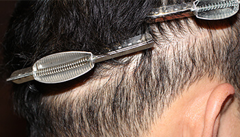 30代 男性 I.Y.さん　瘢痕 自毛植毛（NC-MIRAI法） 400株の症例（施術前）