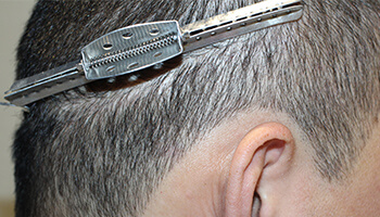 30代 男性 I.Y.さん　瘢痕 自毛植毛（NC-MIRAI法） 400株の症例（施術後）