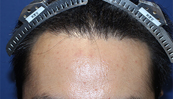 30代 男性 K.T.さん　生え際 自毛植毛（NC-MIRAI法） 1,000株の症例（施術後）