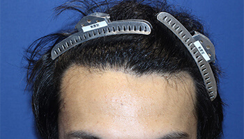 30代 男性 I.Y.さん　前頭部・頭頂部・つむじ 自毛植毛（MIRAI法） 2,500株の症例（施術後）