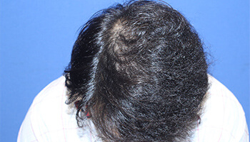 30代 男性 I.Y.さん　前頭部・頭頂部・つむじ 自毛植毛（MIRAI法） 2,500株の症例（施術後）