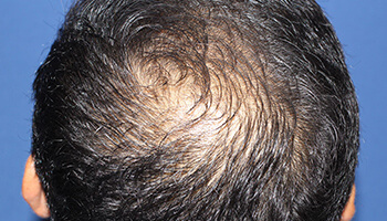 40代 男性 I.M.さん　頭頂部・つむじ 自毛植毛（MIRAI法） 2,000株の症例（施術前）