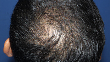 40代 男性 I.M.さん　頭頂部・つむじ 自毛植毛（MIRAI法） 2,000株の症例（施術後）