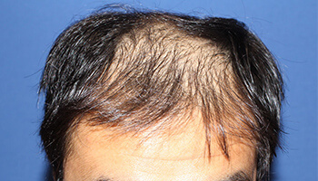 40代 男性 O.K.さん　生え際・前頭部 自毛植毛（MIRAI法） 2,000株の症例（施術前）