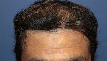 40代 男性 O.K.さん　生え際・前頭部 自毛植毛（MIRAI法） 2,000株の症例（施術後）