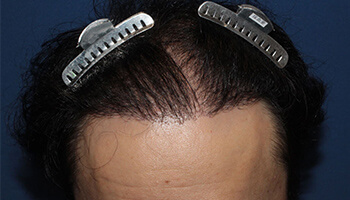 40代 男性 K.S.さん　生え際・前頭部 自毛植毛（MIRAI法） 3,000株の症例（施術後）