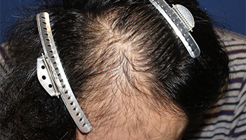 40代 男性 K.S.さん　生え際・前頭部 自毛植毛（MIRAI法） 3,000株の症例（施術前）