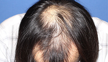 	30代 男性 N.N.さん　生え際 自毛植毛（NC-MIRAI法） 2,000株の症例（施術前）
