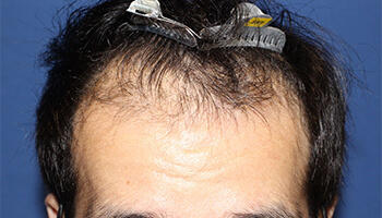 30代 男性 Y.M.さん　前頭部 自毛植毛（MIRAI法） 2,000株の症例（施術後）