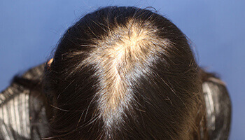 女性の自毛植毛の手術前の頭頂部の写真