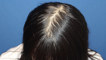女性の自毛植毛の手術後の頭頂部の写真
