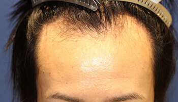30代 女性 R.N.さん 生え際・頭頂部の自毛植毛（MIRAI法） 1.600株の症例（施術前）