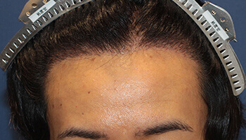 30代 女性 R.N.さん 生え際・頭頂部の自毛植毛（MIRAI法） 1.600株の症例（施術後）