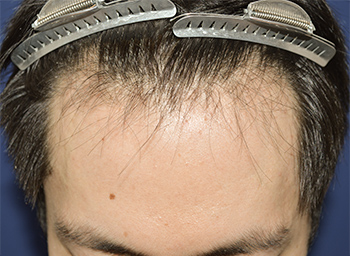30代 男性 T.R.さん 生え際 自毛植毛（MIRAI法） 1,400株の症例（施術前）