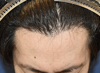 30代 男性 T.R.さん 生え際 自毛植毛（MIRAI法） 1,400株の症例（施術後）