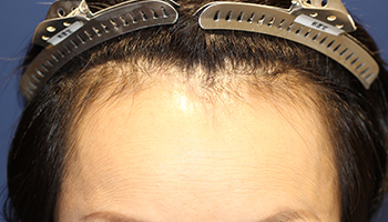 牽引性脱毛症の症例 30代 女性 施術前