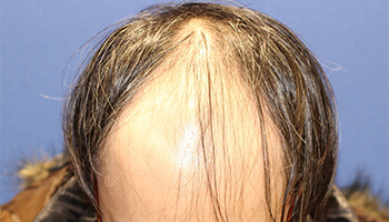30代 男性 A.T.さん　生え際・前頭部・頭頂部 自毛植毛（MIRAI法） 3,000株の症例（施術前）