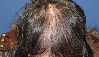 30代 男性 A.T.さん　生え際・前頭部・頭頂部 自毛植毛（MIRAI法） 3,000株の症例（施術後）