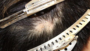 30代 男性 S.Y.さん　M字・瘢痕 自毛植毛（MIRAI法） 1,450株の症例（施術前）