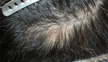 30代 男性 S.Y.さん　M字・瘢痕 自毛植毛（MIRAI法） 1,450株の症例（施術後）