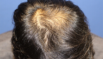 30代 男性 S.K.さん　頭頂部・つむじ 自毛植毛（MIRAI法） 1,500株の症例（施術前）