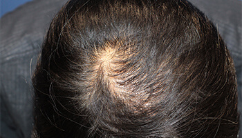 30代 男性 S.K.さん　頭頂部・つむじ 自毛植毛（MIRAI法） 1,500株の症例（施術後）