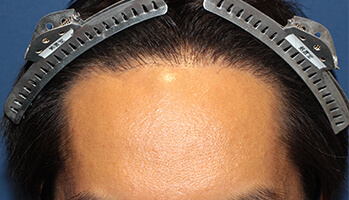 30代 男性 K.M.さん　生え際・頭頂部 自毛植毛（MIRAI法） 1,500株の症例（施術後）