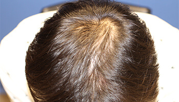 30代 男性 K.M.さん　生え際・頭頂部 自毛植毛（MIRAI法） 1,500株の症例（施術前）