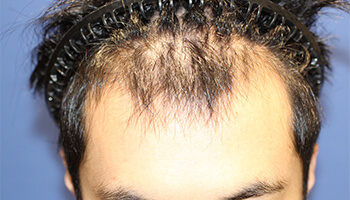 20代 男性 A.N.さん　生え際・前頭部 自毛植毛（MIRAI法） 2,200株の症例（施術前）