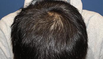 20代 男性 A.N.さん　生え際・前頭部 自毛植毛（MIRAI法） 2,200株の症例（施術後）