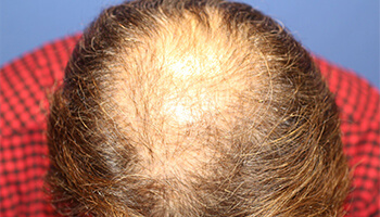 50代 男性 H.Tさん　生え際・前頭部・側頭部 自毛植毛（MIRAI法） 2,800株の症例（施術前）