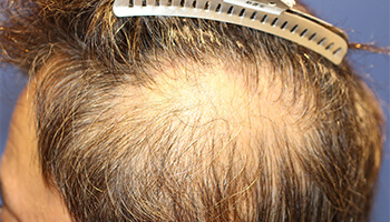 50代 男性 H.Tさん　生え際・前頭部・側頭部 自毛植毛（MIRAI法） 2,800株の症例（施術前）
