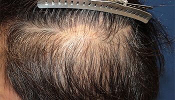 50代 男性 H.Tさん　生え際・前頭部・側頭部 自毛植毛（MIRAI法） 2,800株の症例（施術後）