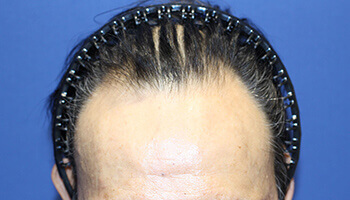 50代 男性 H.A.さん 生え際・前頭部の自毛植毛（NC-MIRAI法） 2,800株の症例（施術前）