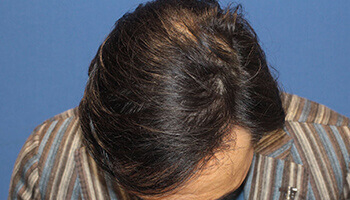 50代 男性 H.A.さん 生え際・前頭部の自毛植毛（NC-MIRAI法） 2,800株の症例（施術後）