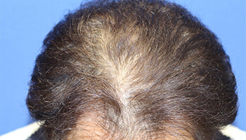 60代 男性 S.H.さん　生え際・前頭部 自毛植毛（NC-MIRAI法） 2,500株の症例（施術前）