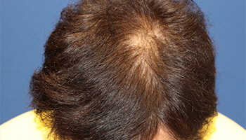 60代 男性 S.H.さん　生え際・前頭部 自毛植毛（NC-MIRAI法） 2,500株の症例（施術後）