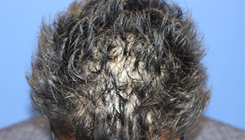 30代 男性 F.A.さん　前頭部・頭頂部 自毛植毛（MIRAI法） 1,300株の症例（施術前）