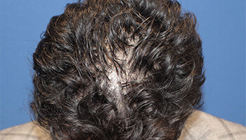 30代 男性 F.A.さん　前頭部・頭頂部 自毛植毛（MIRAI法） 1,300株の症例（施術後）