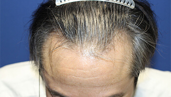 60代 男性 I.M.さん　生え際・前頭部・頭頂部 自毛植毛（MIRAI法） 2,500株の症例（施術前）