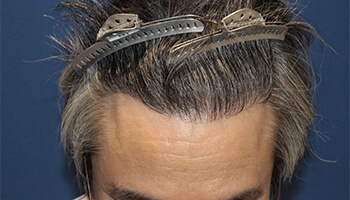 60代 男性 I.M.さん　生え際・前頭部・頭頂部 自毛植毛（MIRAI法） 2,500株の症例（施術後）