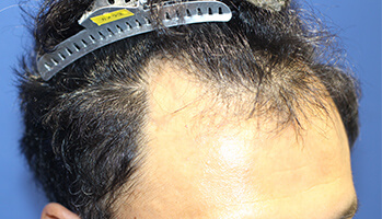 40代 男性 Y.T.さん　生え際 自毛植毛（MIRAI法） 2,000株の症例（施術前）