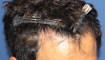 40代 男性 Y.T.さん　生え際 自毛植毛（MIRAI法） 2,000株の症例（施術後）