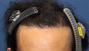 40代 男性 S.T.さん 生え際・頭頂部の自毛植毛（MIRAI法） 3,200株の症例（施術後）
