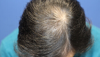 40代 男性 S.T.さん 生え際・頭頂部の自毛植毛（MIRAI法） 3,200株の症例（施術前）