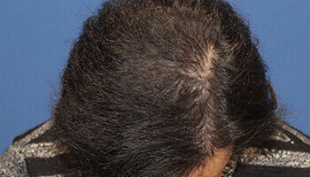 40代 男性 S.T.さん 生え際・頭頂部の自毛植毛（MIRAI法） 3,200株の症例（施術後）