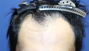 30代 男性 K.J.さん 生え際・つむじの自毛植毛（MIRAI法） 1,000株の症例（施術前）