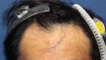 30代 男性 K.J.さん 生え際・つむじの自毛植毛（MIRAI法） 1,000株の症例（施術後）